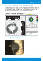 Предварительный просмотр 114 страницы OCULUS Pentacam Interpretation Manual