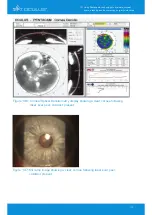 Предварительный просмотр 115 страницы OCULUS Pentacam Interpretation Manual