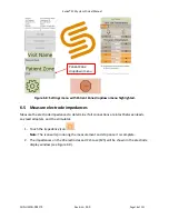 Preview for 18 page of SALUDA MEDICAL Evoke SCS System Clinical Manual