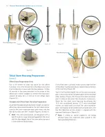 Предварительный просмотр 18 страницы Zimmer Biomet Persona Surgical Technique