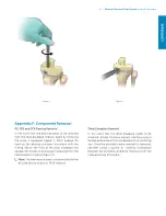 Предварительный просмотр 65 страницы Zimmer Biomet Persona Surgical Technique